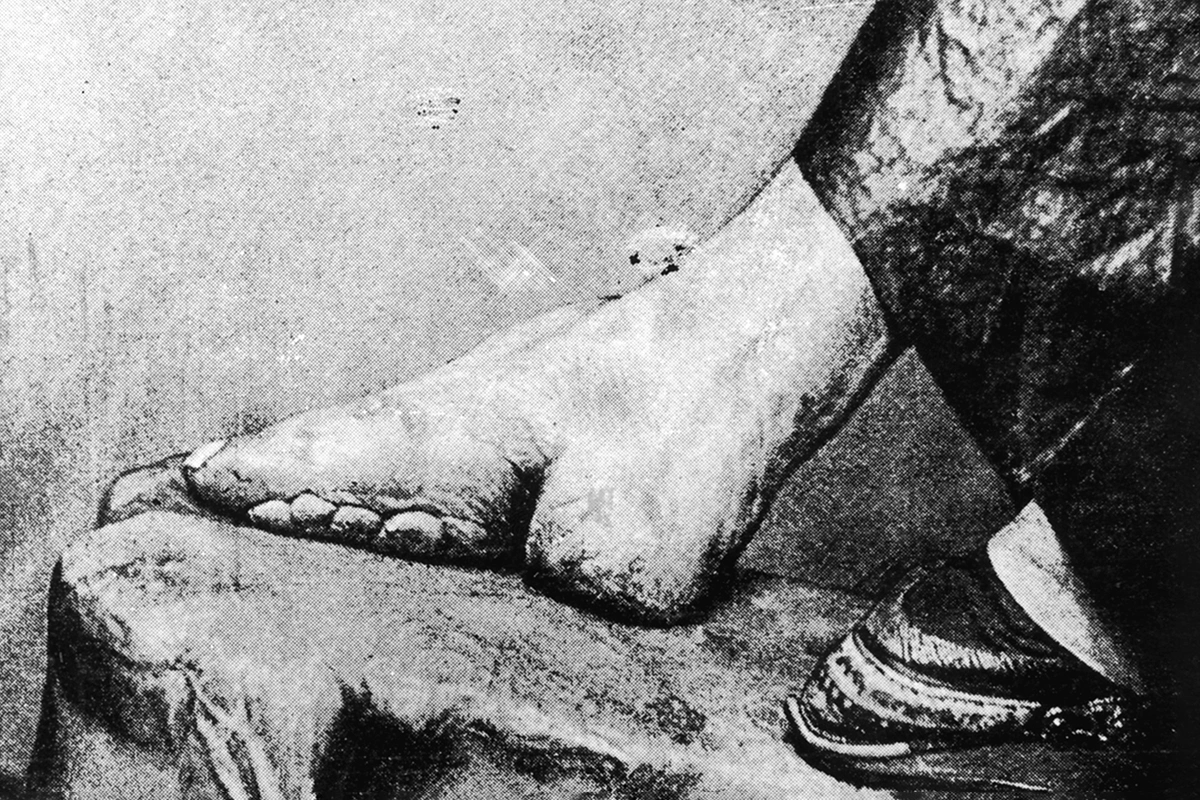 Крупный план ног аристократки-китаянки, деформированных бинтованием, Китай. 1900 год