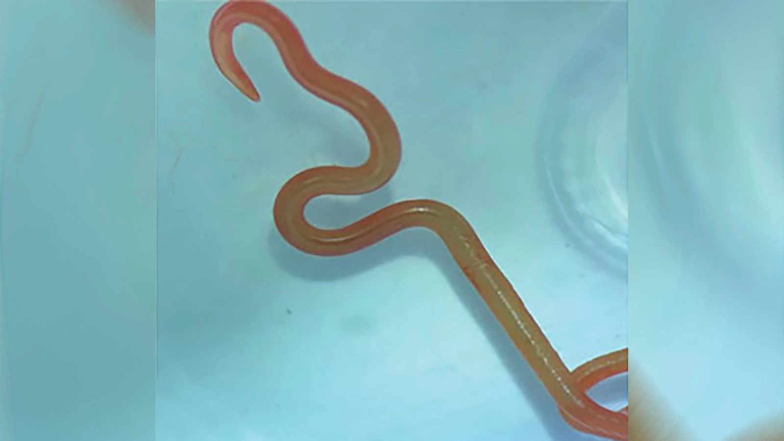 Посмотрите на живого червя длиной 8 см, жившего в мозгу женщины. Фото | РБК  Life