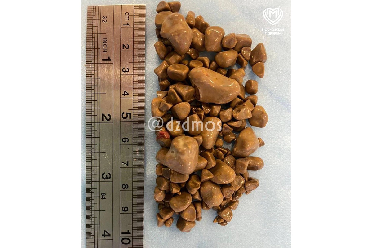 Камни, извлеченные из почек