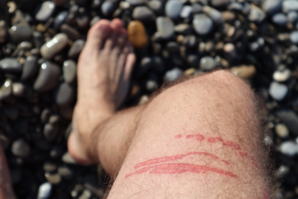 Контакт с медузами и соприкосновение с их щупальцами часто приводит к ожогам на коже