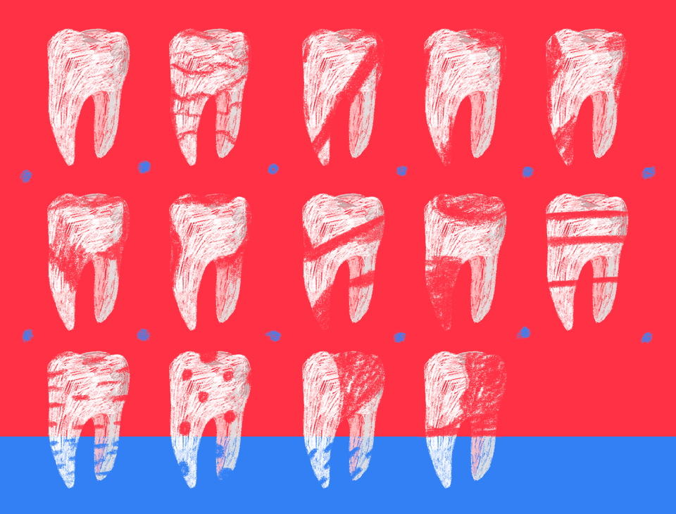 Миф № 4: виниры портят зубы