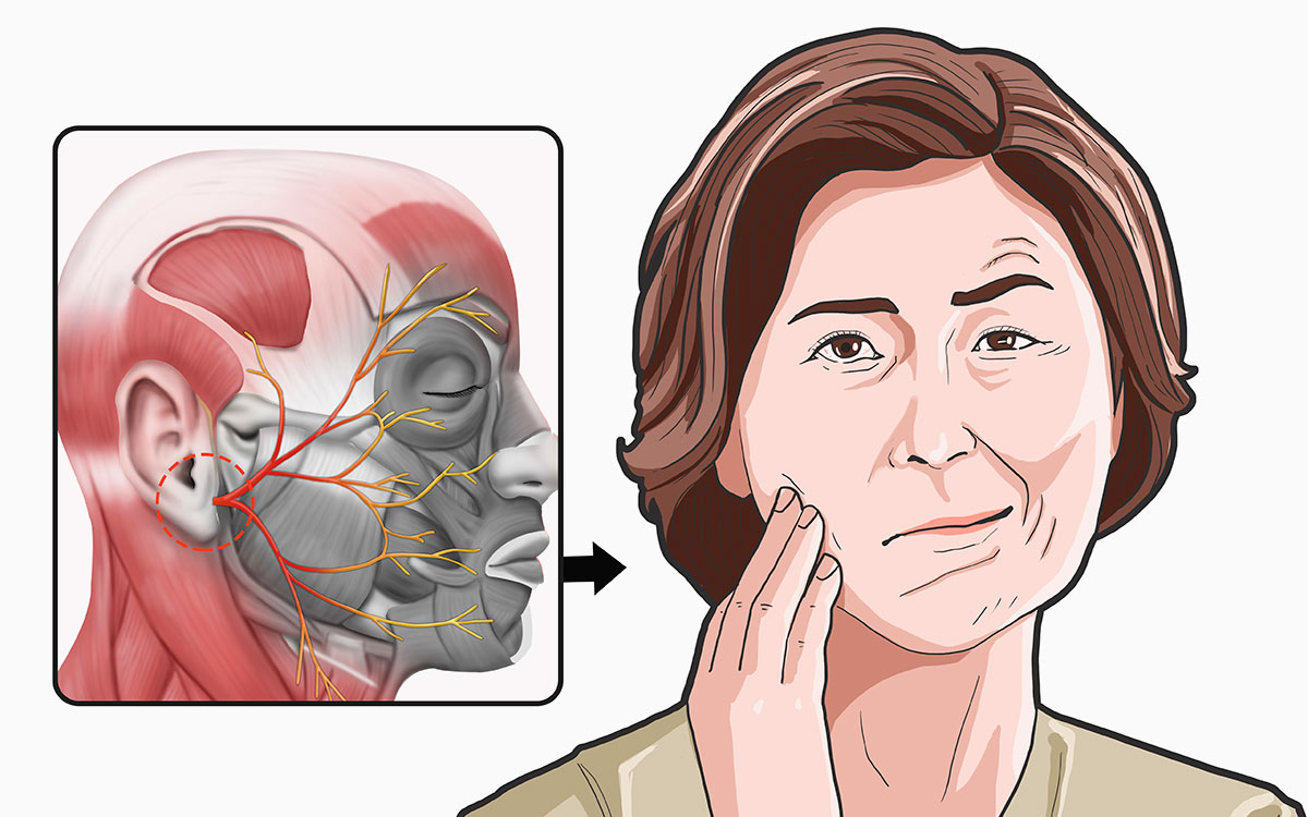 Болезни лицевого нерва