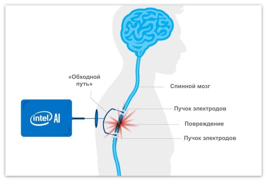 Предполагается создать &laquo;обходной путь&raquo; для спинного мозга путем вживления электродов по обе стороны от поврежденного участка и передачи по нему электрических сигналов