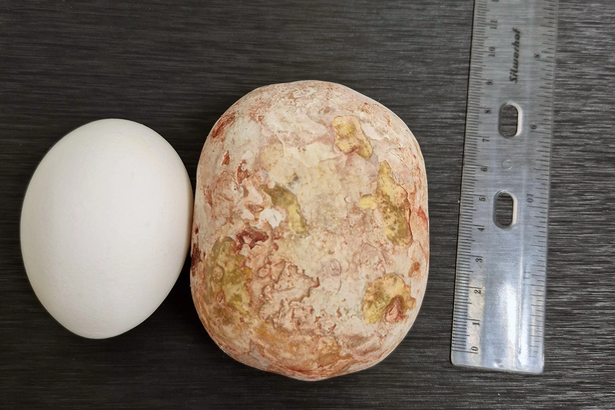 Камень из мочевого пузыря весом примерно 1 кг