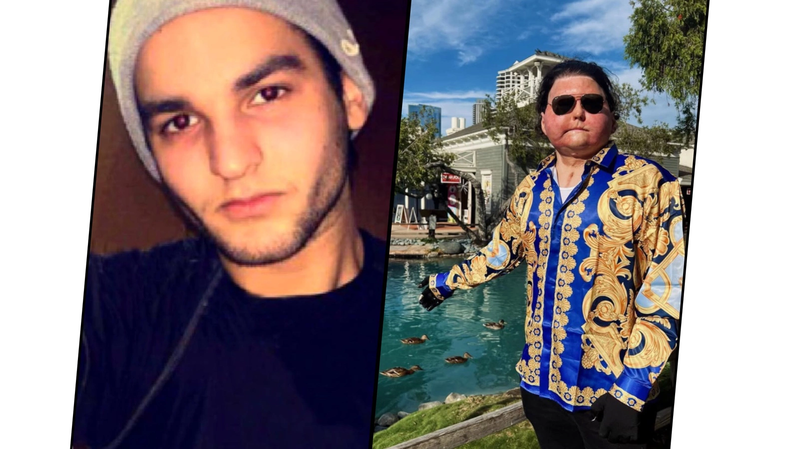 Джо ДиМео до и после пересадки лица и рук