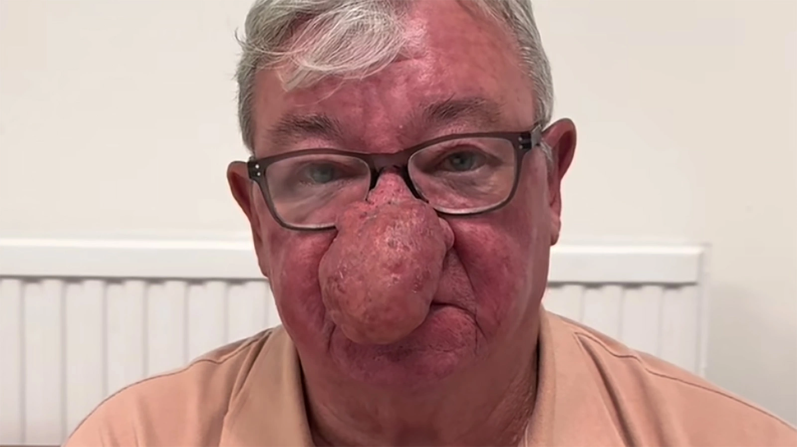 Джерард МакАлис до операции