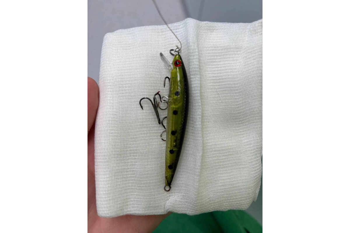 В Москве спасли ребенка, которому в лицо вцепился воблер для рыбалки