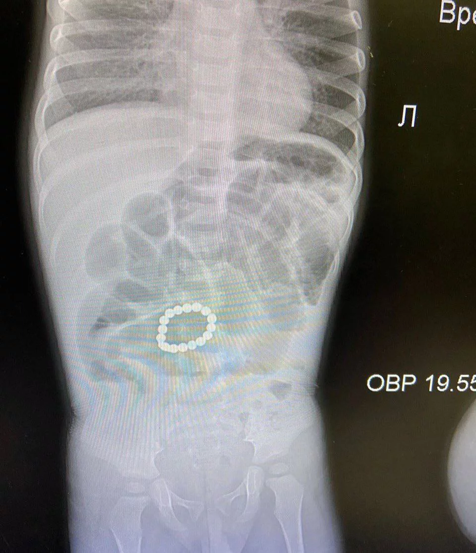 <p>Магнитики в кишечнике ребенка на рентгеновском снимке</p>