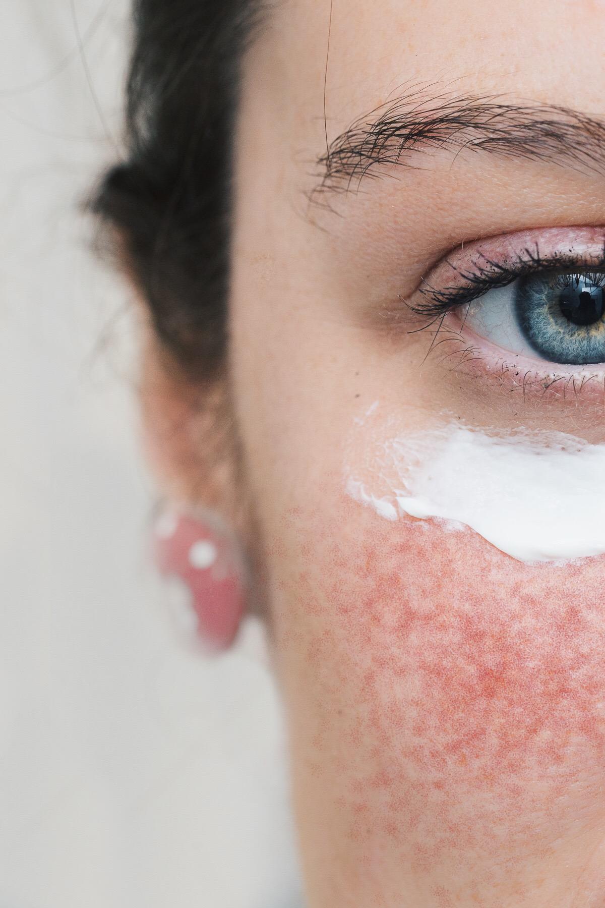 Розацеа &mdash; это хроническое поражение, которое сопровождается высыпаниями