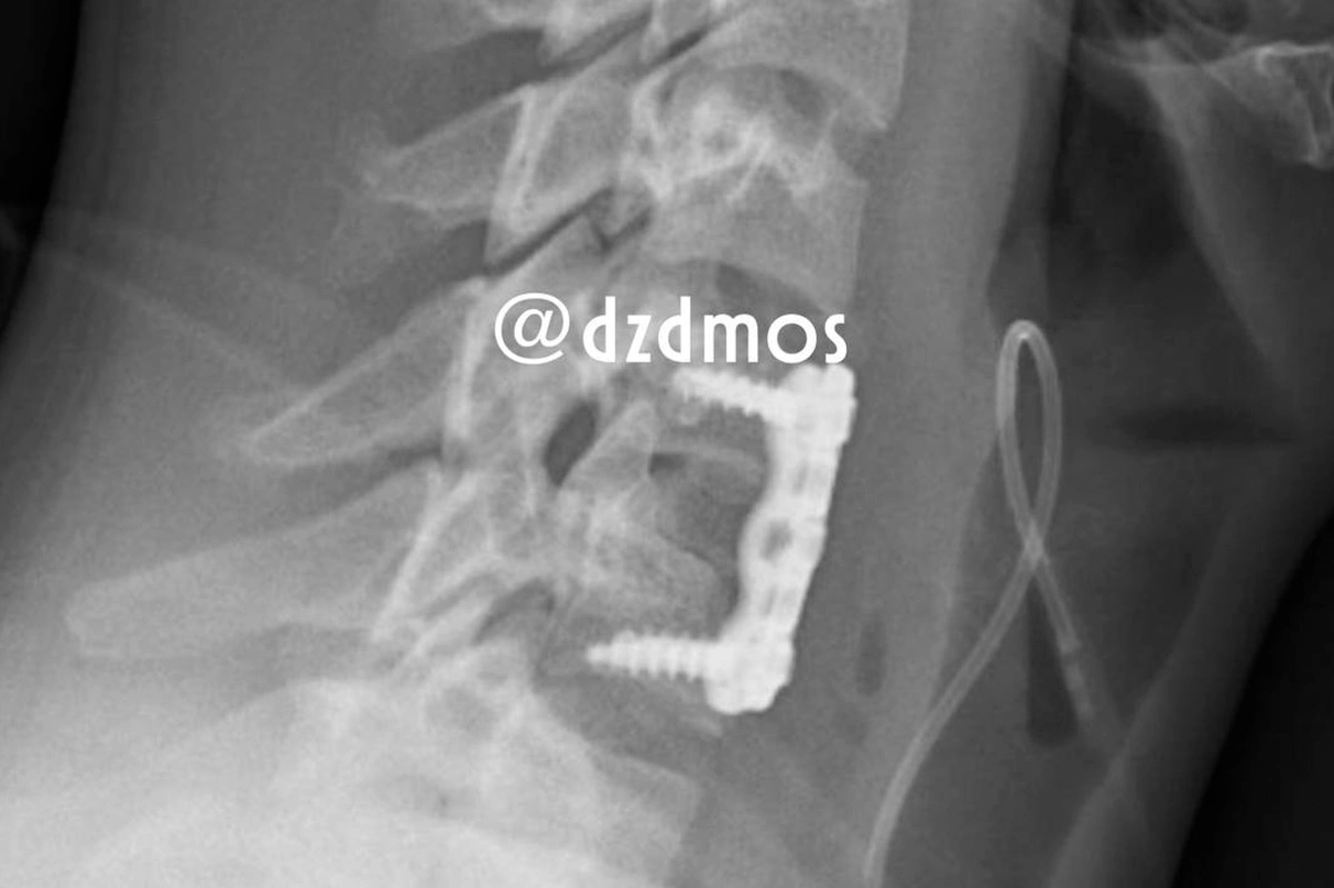 Рентгенограмма после установки аутотрансплантата