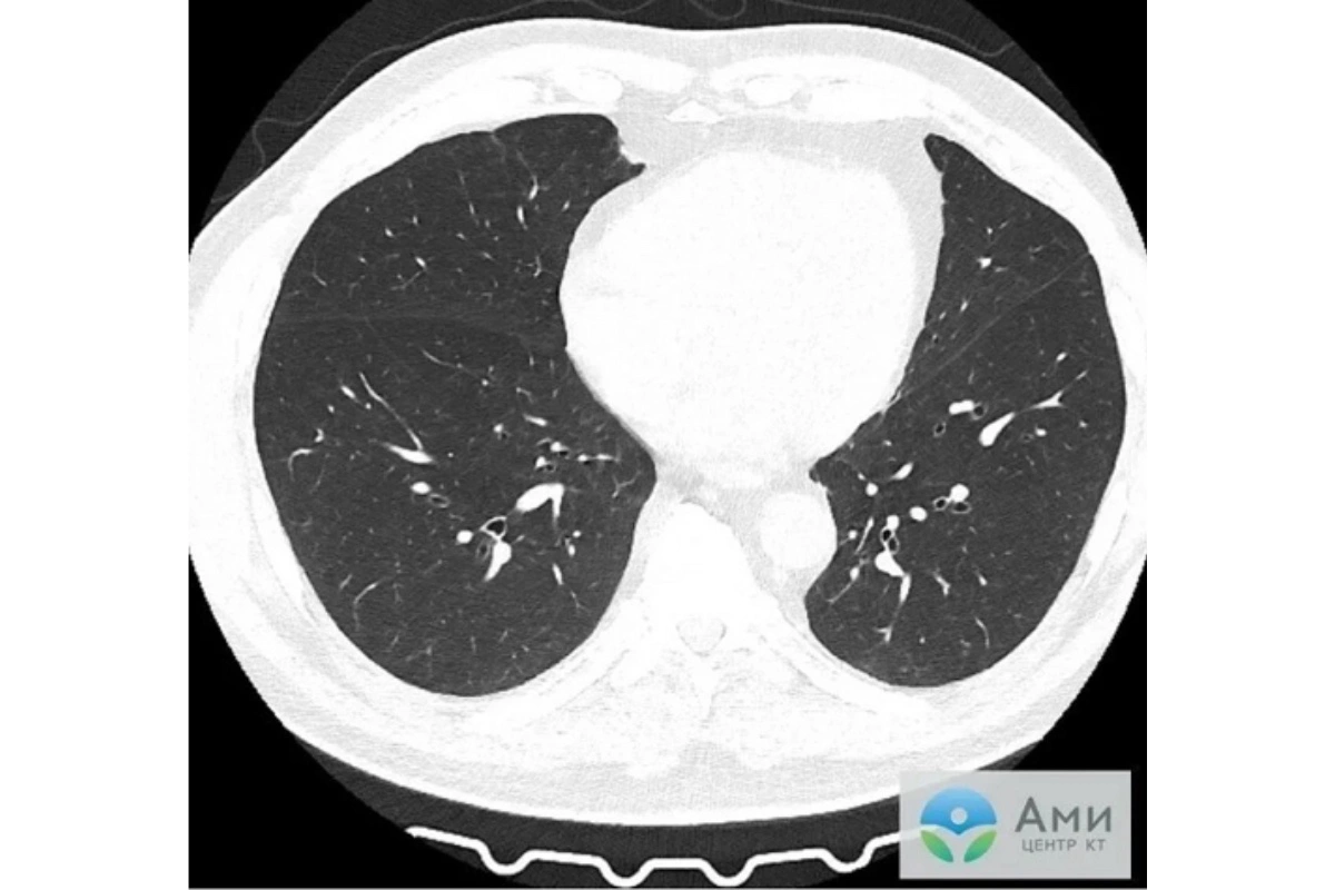 КТ легких до употребления вейпа