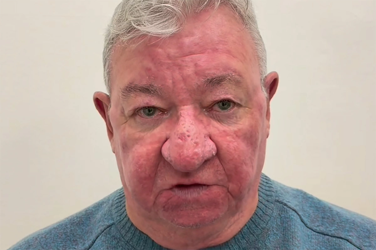 Джерард МакАлис после операции