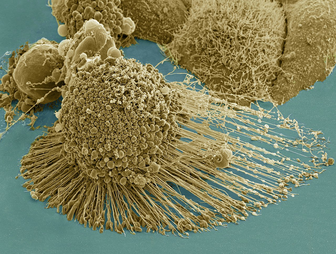 В большинстве видов рака теломераза поддерживает стабильную длину теломер, делая такие клетки потенциально бессмертными. На фото раковые клетки HeLa, выделенные в 1951 году из опухоли шейки матки Генриетты Лакс (Henrietta Lacks). Они живы и до сих пор используются цитологами &mdash; например, с их помощью была разработана вакцина против полиомиелита.