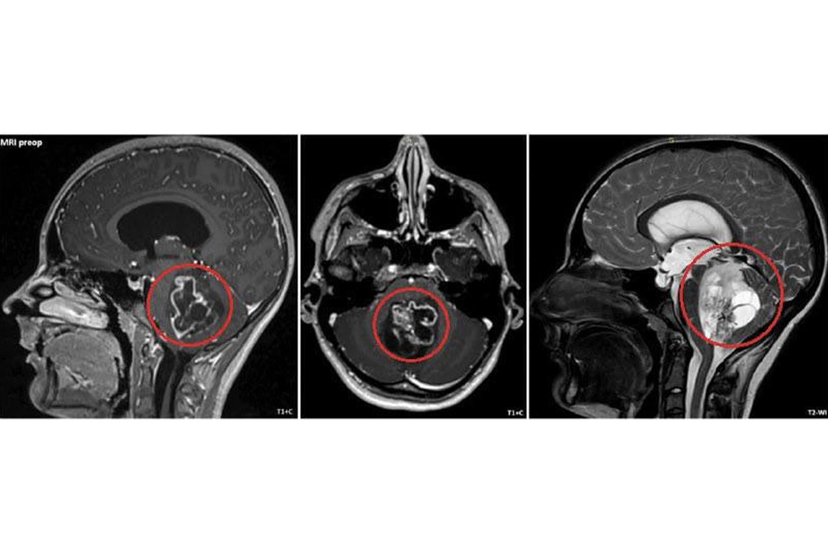 Объемное новообразование — пятисантиметровая опухоль в задней черепной ямке