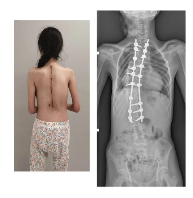 <p>Спина и снимок позвоночника девочки после проведенной операции (угол деформации снижен до 40&deg;)</p>