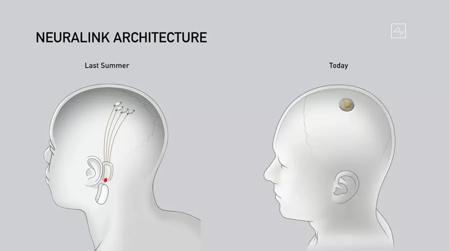 Сравнение старой (слева) версии нейрочипа и новой, которая была представлена на презентации 28 августа. Раньше одним из элементов устройства был внешний передатчик, который размещался за ухом и подключался с помощью нитей к мозгу. Его сочли слишком большим и неудобным. Теперь устройство планируют вживлять под кожу на голове.
