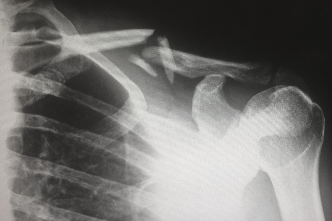 Перелом диагностируют с помощью рентгена, компьютерной или магнитно-резонансной томографии
