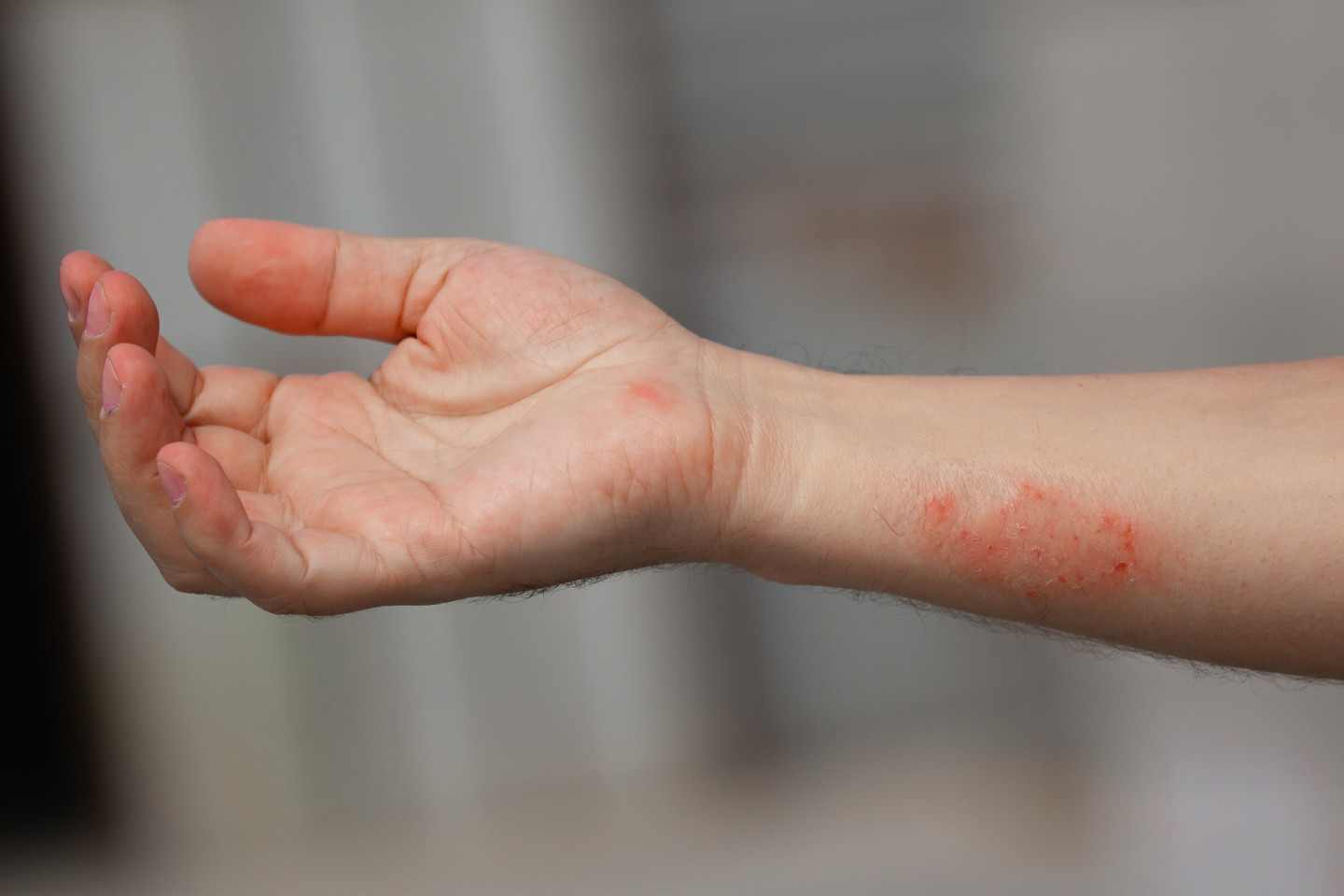 Как выглядит ожог от борщевика: пузыри и покраснения — защитная реакция кожи на контакт с аллергеном