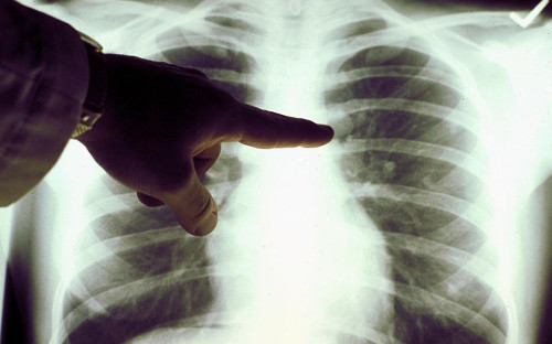 Фото: Photo Courtesy of the American Cancer Society / Getty Images