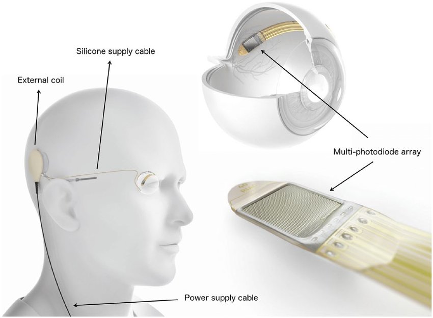 Субретинальный имплантат Alpha AMS компании Retina Implant AG